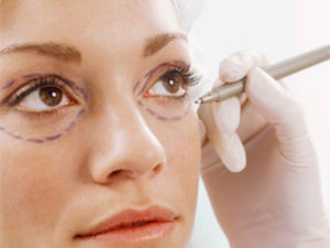 Eyelid Surgery Los Angeles and Beverly Hills, Blepharoplasy Los Angeles and Beverly Hills