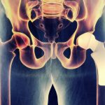 When You Should Consider a Total Hip Replacement